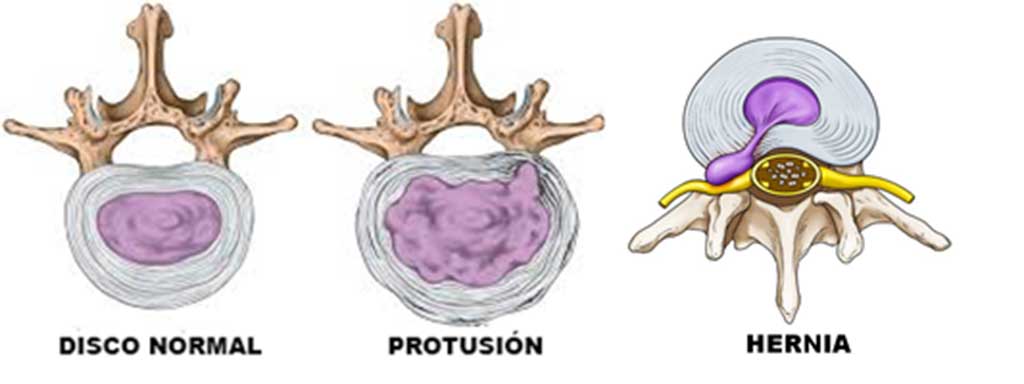 hernia discal lumbar y protusión